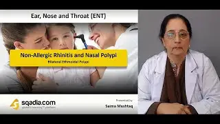 Non-Allergic Rhinitis and Nasal Polypi | Bilateral Ethmoidal Polypi