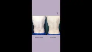CoolSculpting Before and After Results - Love Handles and Belly Fat | The Cosmetic Skin Clinic