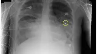 Acute Respiratory #3: ARF, ARDS,  PE