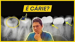 Como Identificar uma Cárie na Radiografia?