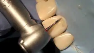 Finishing and repairing composite restoration