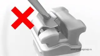 Внимание! Открывание брекетов QuicKlear