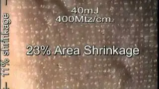 How Fraxel Re:Pair Shrinks the Skin - Orange County Laser Resurfacing