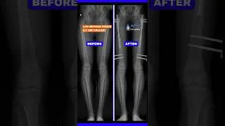 X-RAY / LON METHOD FEMUR / HE GOT 5,7 CM TALLER! #limblengtheningsurgery #leglengtheningsurgery
