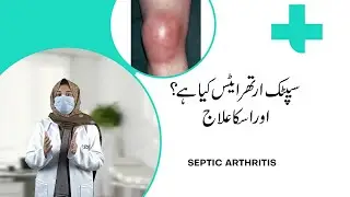 Septic Arthritis - Symptoms and Causes!