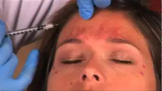 What to Expect from your BOTOX&reg; Cosmetic Treatment