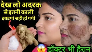 अदरक से झाइयां हटाने का कमाल का तरीका Reduce Melasma, Pigmentation, Discolouration Blackspots