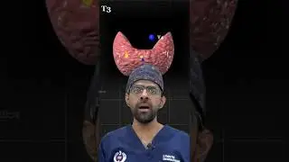 Kya Hai Thyroid Nodules? Explained in Detail | Diagnosis & Treatment #thyroid #thyroidproblems