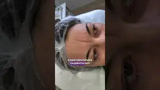 Реально ли избавиться от такой глубокой меж бровной морщины? #косметология #ботокс #диспорт