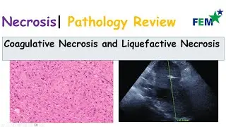 Pathology Review | Necrosis | Coagulative Necrosis and Liquefactive Necrosis