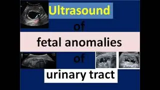 Ultrasound of fetal anomalies of urinary tract