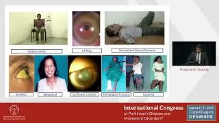 Wilson's Disease