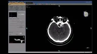 Case-5, ICA Aneurysm, 01-02-2026