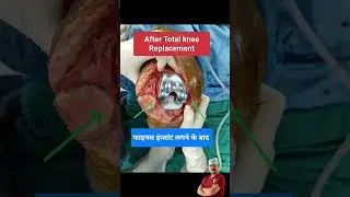 total knee replacement #shorts #trendingshorts #tkr #totalkneereplacementrecovery