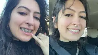 your gen z rdh gets their braces off