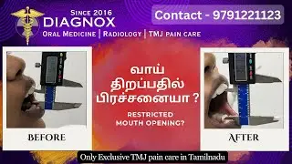 வாய் திறப்பதில் பிரச்சனையா ? It's a sign of TMJ disorder