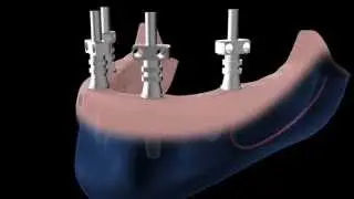 Bone System Easy-on-Four