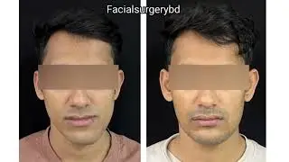 Deviated lower jaw correction  #Facialsurgerybd #Abdullahmasud