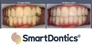 Teeth movement