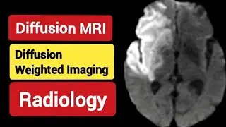 Diffusion MRI - DWI - RADIOLOGY