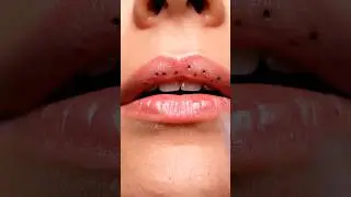 You Won&rsquo;t Believe These Upper Lip Blackheads | Vacuum ASMR