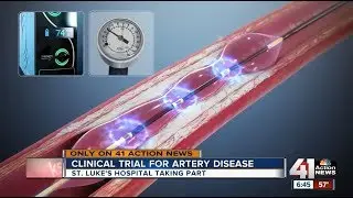 KSHB: Game-changing new procedure uses sound waves to break up blockages in arteries