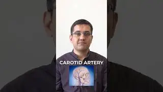 Treatment for Carotid Artery Issues 🤯