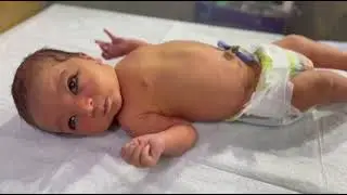 Severe Neonatal Jaundice Case ⚠️ | NNJ Baby at Risk of Brain Damage