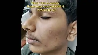 #LaserCarbonFacial #ahmednagar #tattoo #tattooartist #designtattoo #carbonfacial #laserfacial