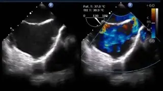 Anomalous pulmonary venous drainage