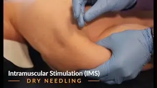 Intramuscular Stimulation IMS
