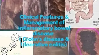 Clinical Features & Management of Inflammatory bowel disease (Crohn's disease & Ulcerative colitis)