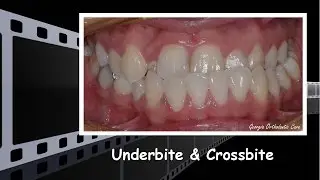 Underbite & Unilateral Crossbite