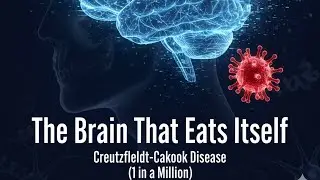 The Rare Brain Disease That Eats Itself: Creutzfeldt-Jakob Disease