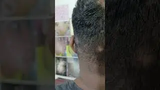 Alopecia Areata + Tinea on Face
