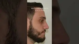 MALE RHINOPLASTY TRANSFORMATION  #rhinoplastysurgeon #malerthinoplasty #rhinoplastyspecialist