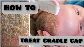 How to Treat Cradle Cap.Newborn baby. #newborn #cradlecap