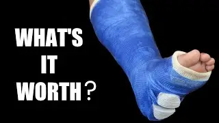 Broken Leg (Tibia and Fibula) Settlements: Car Accidents and More