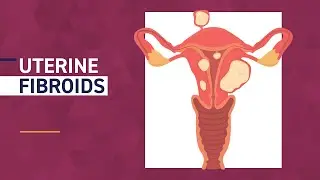 Fibroid Awareness Month | Common Fibroid Symptoms
