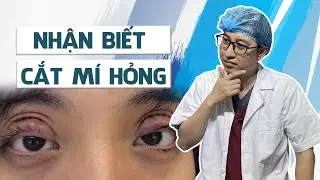 7 yếu tố nhận biết cắt mí mắt bị hỏng | Bs Mạnh