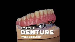 Bar over Denture with Locator
