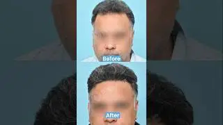 5500 Grafts Hair Transplant Before After Result | Hair Transplant Results