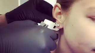 K&otilde;rvaaugustamine, teine auk -Studex System 75 / Ear piercing with Studex System 75