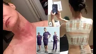 Delta employees say new uniforms are giving them rashes