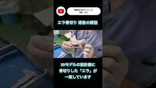 【エラ骨切り手術後の解説】手術後の解説！　＃エラ　＃輪郭形成　＃骨切り　＃美容整形　＃輪郭矯正