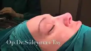 Rhinoplasty Before and After - Prof.Dr. Suleyman Tas