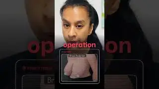 What is Breast reduction surgery?