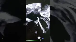 Huge pericardial effusion with ASD #education #Pericardialeffusion