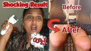 Shocking Result 😨|Agaro Callus Remover|Full review in tamil|Heel Crack Solution 💯