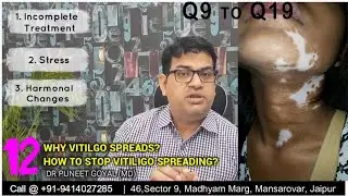 Vitiligo FAQ Part 3 (Q9 to Q19) | Vitiligo Treatment at Renova Skin & laser Clinic, Jaipur